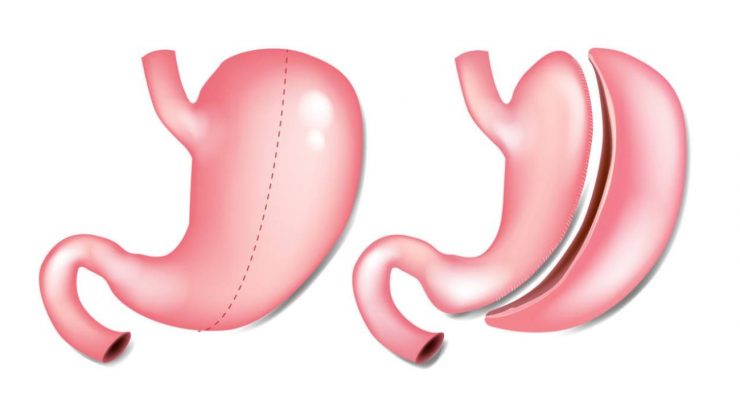 Manga gástrica: pros y contras | ObesiMad